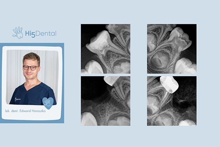 Bezpieczna atraumatyczna ekstrakcja mleczaka