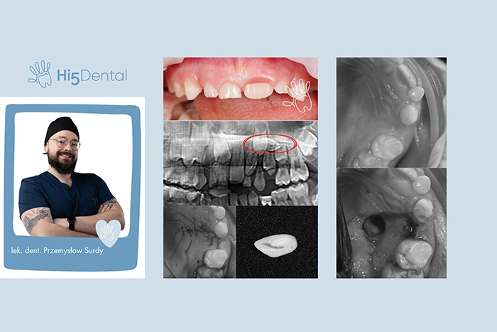 Chirurgiczne usunięcie zęba zatrzymanego u dziecka