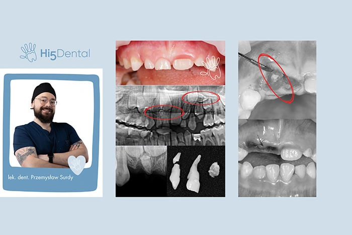 Co może blokować wyrzynanie się „jedynek” u dzieci?