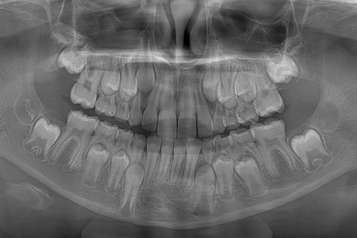 Czy mleczaki mają korzenie?