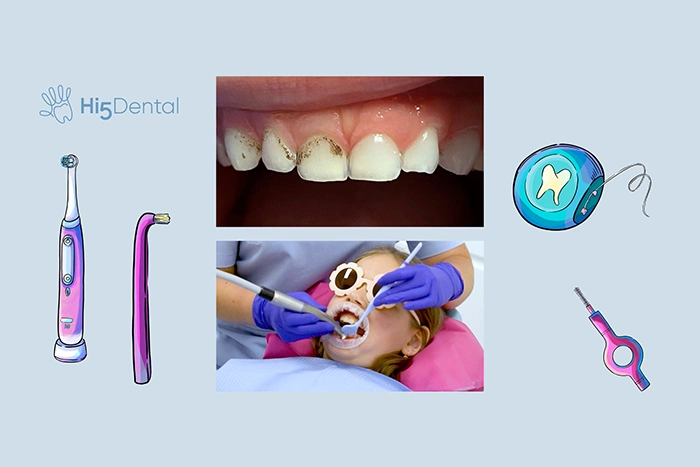 Czarny osad na zębach mlecznych u dzieci – czy trzeba się martwić?