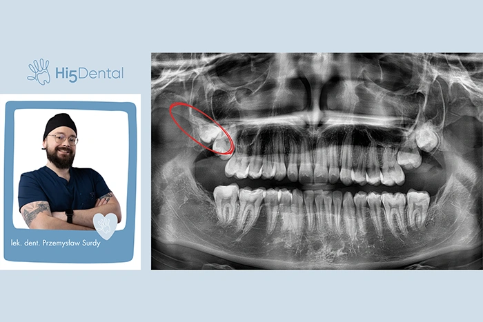 Germektomia – po co usuwać zawiązki zębów mądrości?