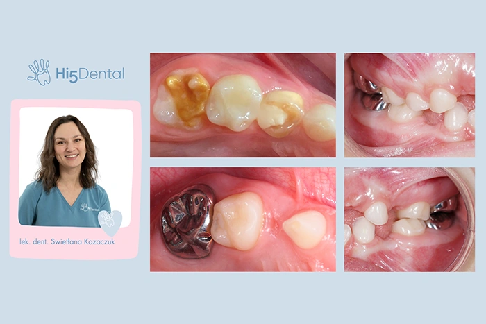 Hipoplazja zębów u dzieci – jak pomóc małym pacjentom z MIH?