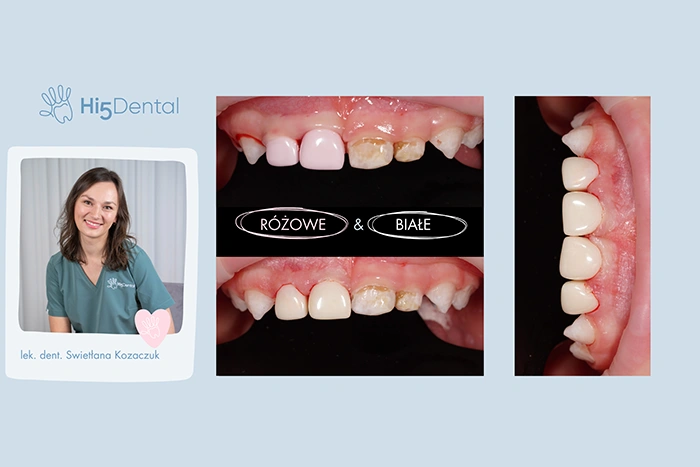 Korony cyrkonowe na zęby mleczne – jak wygląda leczenie?