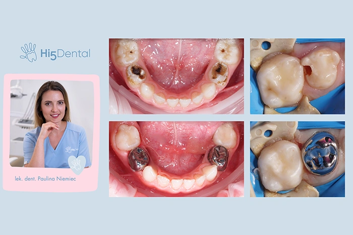 Korony stalowe dla dzieci