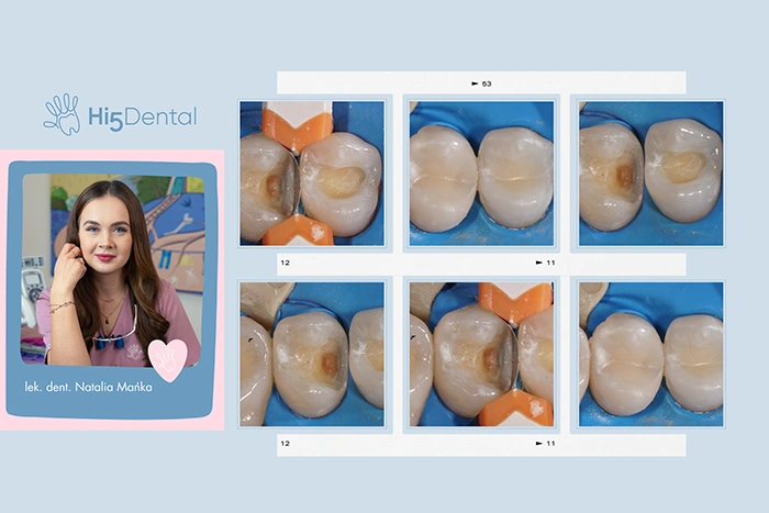 Leczenie próchnicy między zębami – jak sprawdzić, czy wszystko jest dobrze?