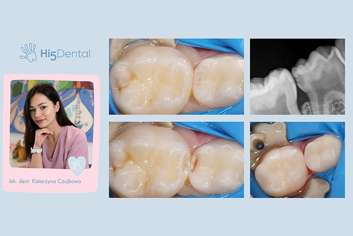 Leczenie próchnicy między zębami u dzieci – dlaczego jest takie ważne?