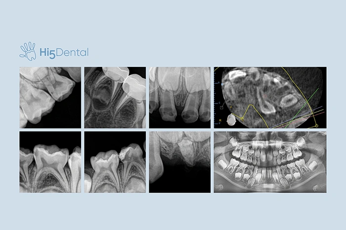 Rentgen zębów mlecznych u dzieci – kiedy i po co się go wykonuje?