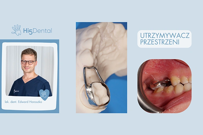 Utrzymywacz przestrzeni – co to jest i kiedy go stosujemy?