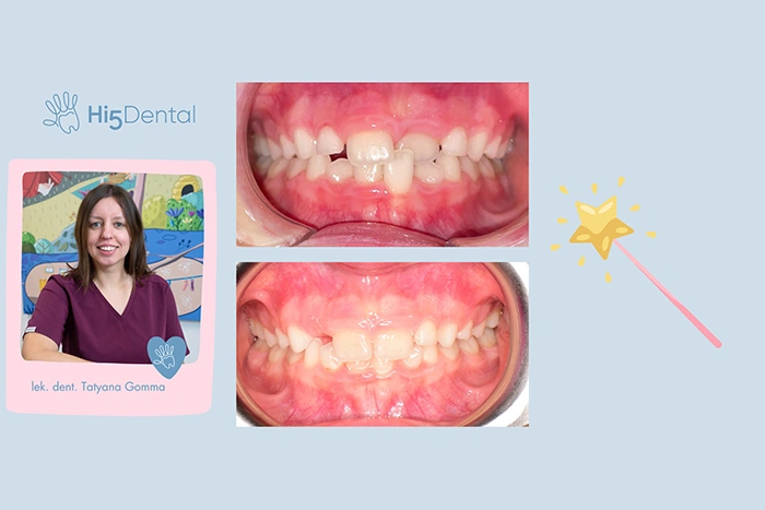 Wczesne leczenie ortodontyczne ma MOC!