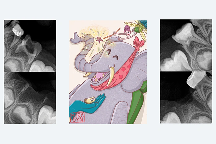 Zalecenia po usunięciu zęba mlecznego (wyrwanie mleczaka)