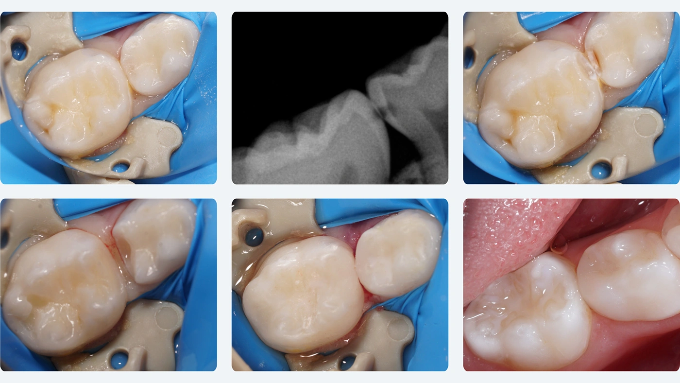 Leczenie próchnicy między zębami mlecznymi – etapy krok po kroku.