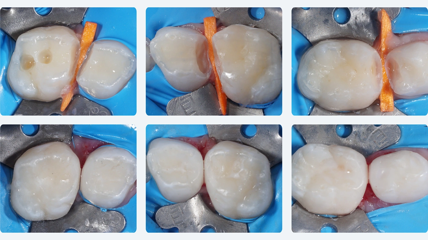 Mniej wizyt, więcej komfortu – leczenie 2 zębów podczas 1 wizyty