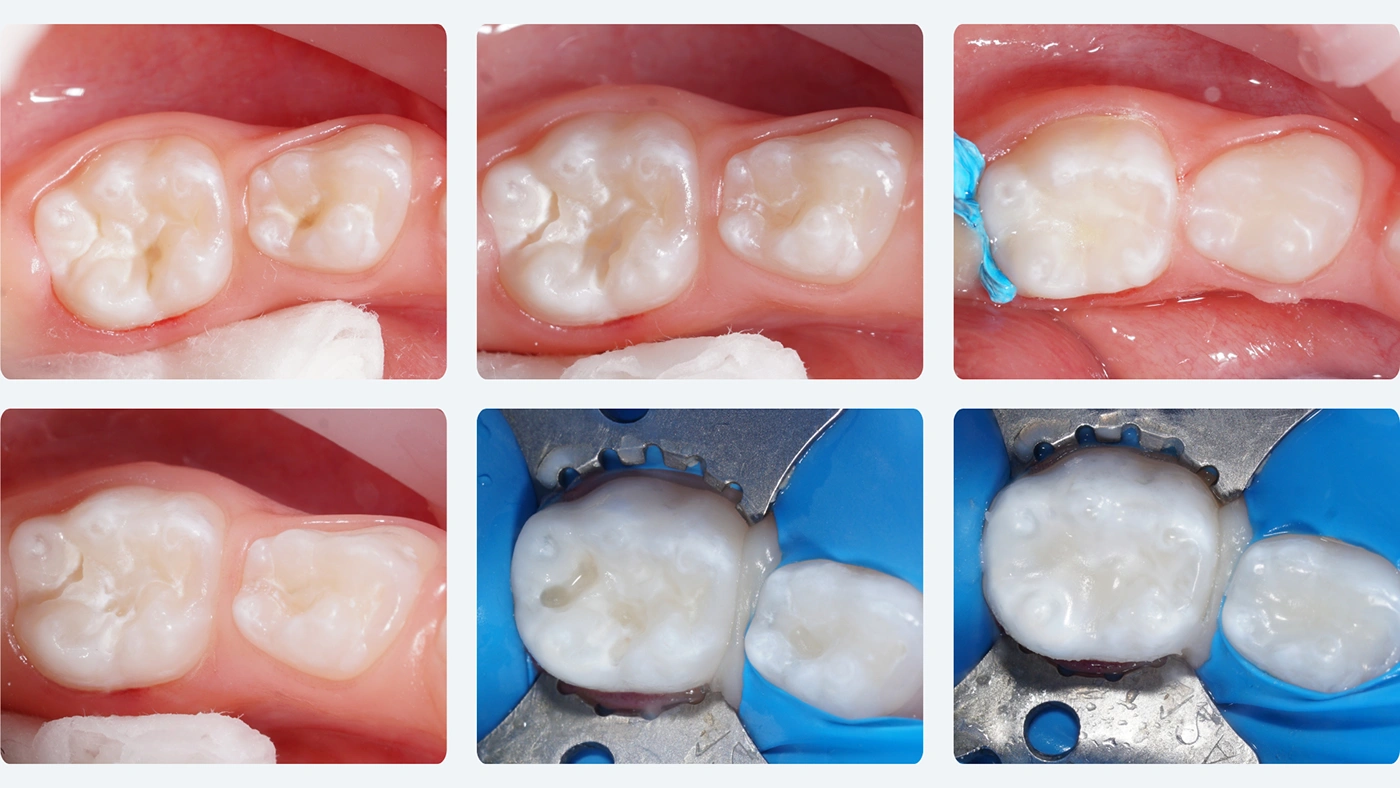 Odbudowa małych ubytków i profilaktyka w jednym zabiegu