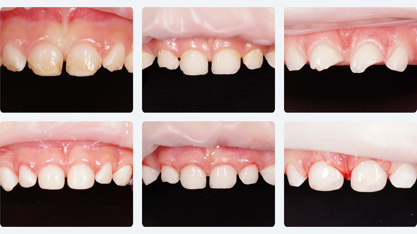 Estetyczne i trwałe odbudowy zębów mlecznych przednich