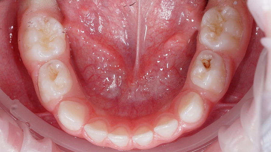 Wczesne leczenie ortodontyczne