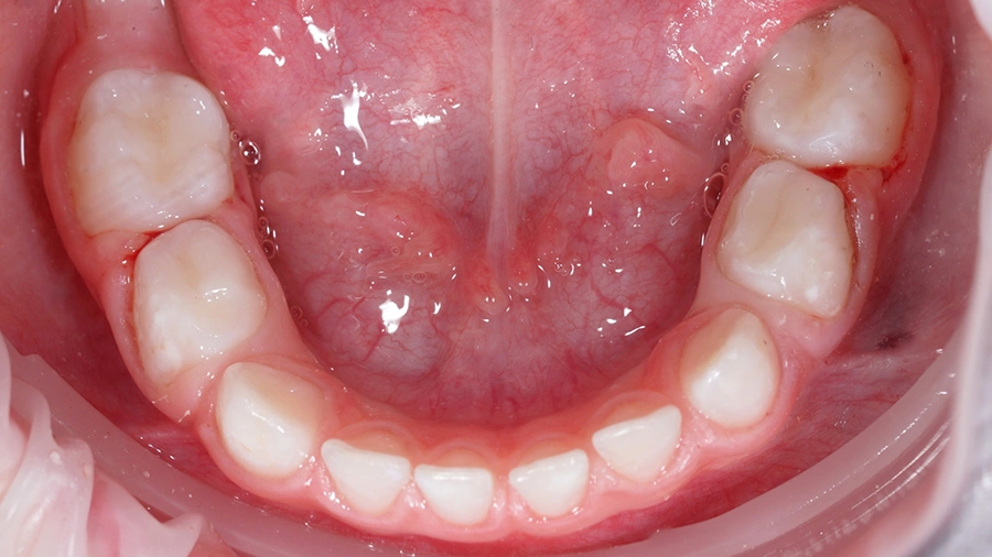 Wczesne leczenie ortodontyczne